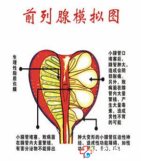 前列腺結石給男性帶來的危害有?