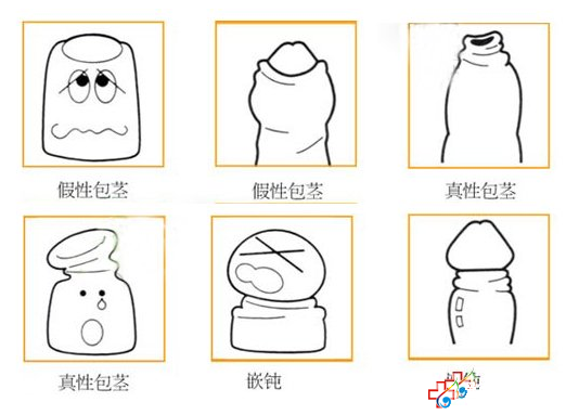 包皮過長和包莖的區別有哪些?九江醫大醫院