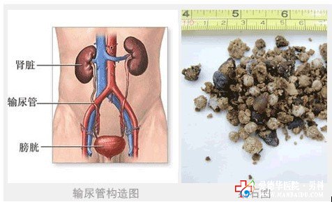 男性腎結石是怎么形成的