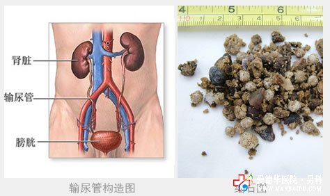 輸尿管結(jié)石的危害不可忽視
